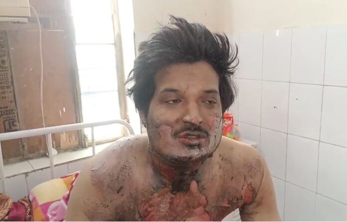 30 प्रतिशत झुलसा युवक अस्पताल में भर्ती