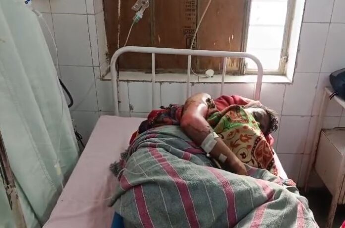 891 हादसे में 30 वर्षीय युवक उमेश गंभीर रूप से झुलस गया