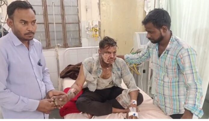 976 काम के दौरान युवक झुलसा, हालत गंभीर जयपुर रेफर