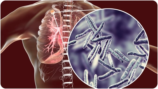 lungs-cough-tb_28942e9a1219a6c10.jpg