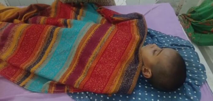 6 दिन तक तड़पता रहा 40% झुलसा मासूम