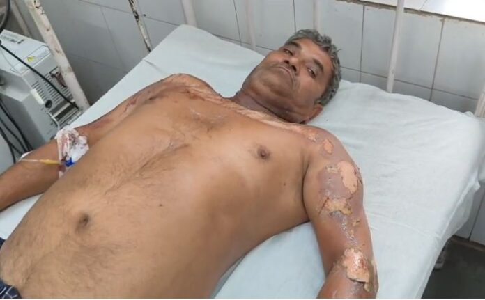 ट्रांसफार्मर हादसा किसान झुलसा