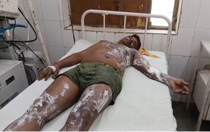 996 गैस पाइपलाइन लीकेज से लगी आग में श्रमिक 30% झुलसा