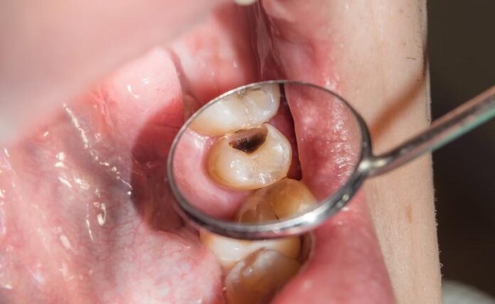 nimj9pd_tooth-cavity_625x300_23.jpg