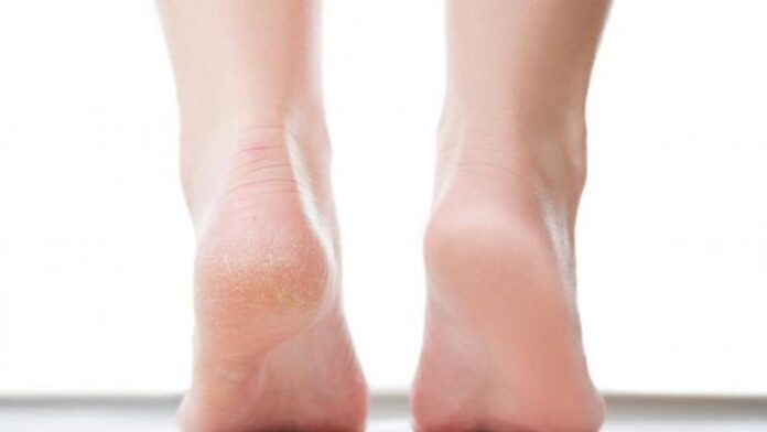 cracked_heels-sixteen_nine.jpg