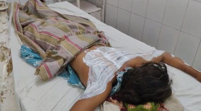 आग से 14 वर्षीय बालिका झुलसी